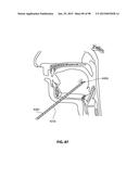 SYSTEMS AND METHODS FOR TREATMENT OF AN AIRWAY DISORDER diagram and image