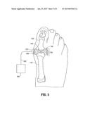 ENERGY-BASED TREATMENT METHODS FOR REFRACTORY GOUT diagram and image