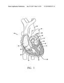 TRANSAPICAL MITRAL VALVE REPAIR METHOD diagram and image