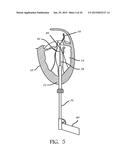 TRANSAPICAL MITRAL VALVE REPAIR METHOD diagram and image