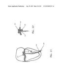 TRANSAPICAL MITRAL VALVE REPAIR METHOD diagram and image