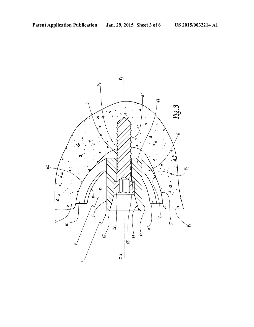 Joint Prosthesis Attachment System, Device And Method - diagram, schematic, and image 04