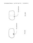 Patient-Adapted Posterior Stabilized Knee Implants, Designs and Related     Methods and Tools diagram and image