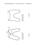 Patient-Adapted Posterior Stabilized Knee Implants, Designs and Related     Methods and Tools diagram and image