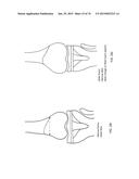 Patient-Adapted Posterior Stabilized Knee Implants, Designs and Related     Methods and Tools diagram and image