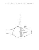 Patient-Adapted Posterior Stabilized Knee Implants, Designs and Related     Methods and Tools diagram and image