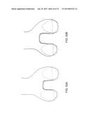 Patient-Adapted Posterior Stabilized Knee Implants, Designs and Related     Methods and Tools diagram and image