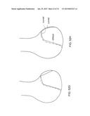 Patient-Adapted Posterior Stabilized Knee Implants, Designs and Related     Methods and Tools diagram and image