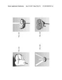 Patient-Adapted Posterior Stabilized Knee Implants, Designs and Related     Methods and Tools diagram and image