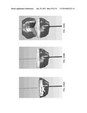 Patient-Adapted Posterior Stabilized Knee Implants, Designs and Related     Methods and Tools diagram and image