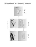 Patient-Adapted Posterior Stabilized Knee Implants, Designs and Related     Methods and Tools diagram and image