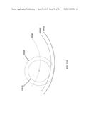 Patient-Adapted Posterior Stabilized Knee Implants, Designs and Related     Methods and Tools diagram and image