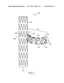 HYBRID BALLOON-EXPANDABLE/SELF-EXPANDING PROSTHESIS FOR DEPLOYMENT IN A     BODY VESSEL AND METHOD OF MAKING diagram and image