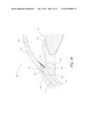 SYSTEM FOR DELIVERING MULTIPLE OCULAR IMPLANTS diagram and image