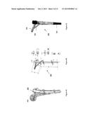 SURGICAL IMPLANT DEVICE, METHOD AND APPARATUS FOR IMPLANTING THEREOF diagram and image