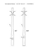 Intramedullary Nail System including Tang-deployment Screw with Male     Interface diagram and image