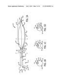 SYSTEMS AND METHODS FOR TREATING A VESSEL USING FOCUSED FORCE diagram and image