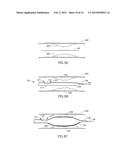 SYSTEMS AND METHODS FOR TREATING A VESSEL USING FOCUSED FORCE diagram and image