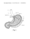 System for treating gastric reflux by tightening a lower esophageal     sphincter diagram and image