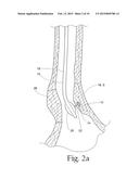 System for treating gastric reflux by tightening a lower esophageal     sphincter diagram and image