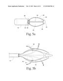 System for treating gastric reflux by tightening a lower esophageal     sphincter diagram and image