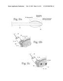 System for treating gastric reflux by tightening a lower esophageal     sphincter diagram and image