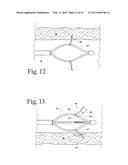 System for treating gastric reflux by tightening a lower esophageal     sphincter diagram and image