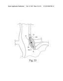 System for treating gastric reflux by tightening a lower esophageal     sphincter diagram and image