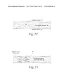 System for treating gastric reflux by tightening a lower esophageal     sphincter diagram and image