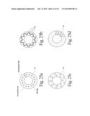 System for treating gastric reflux by tightening a lower esophageal     sphincter diagram and image