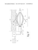 System for treating gastric reflux by tightening a lower esophageal     sphincter diagram and image