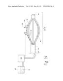 System for treating gastric reflux by tightening a lower esophageal     sphincter diagram and image