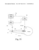 System for treating gastric reflux by tightening a lower esophageal     sphincter diagram and image