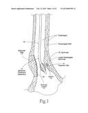 SPHINCTER TREATMENT APPARATUS diagram and image