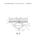 SPHINCTER TREATMENT APPARATUS diagram and image