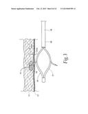 SPHINCTER TREATMENT APPARATUS diagram and image