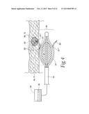 SPHINCTER TREATMENT APPARATUS diagram and image