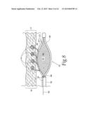 SPHINCTER TREATMENT APPARATUS diagram and image