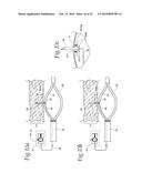 SPHINCTER TREATMENT APPARATUS diagram and image