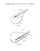 TRANSVASCULAR NERVE STIMULATION APPARATUS AND METHODS diagram and image