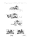 ORTHOPEDIC DUAL POCKET COMPRESSION PLATE AND METHOD OF SURGERY diagram and image