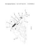 DEVICES AND METHOD OF ACHIEVING BONE FUSION diagram and image