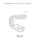 Method For Manufacturing Dental Implant Components diagram and image