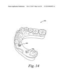 Method For Manufacturing Dental Implant Components diagram and image