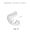 Method For Manufacturing Dental Implant Components diagram and image