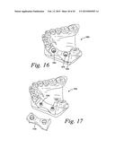 Method For Manufacturing Dental Implant Components diagram and image