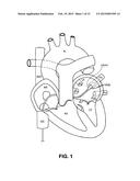 DEVICES AND METHODS FOR DENERVATION OF THE NERVES SURROUNDING THE     PULMONARY VEINS FOR TREATMENT OF ATRIAL FIBRILLATION diagram and image