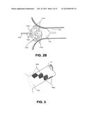 DEVICES AND METHODS FOR DENERVATION OF THE NERVES SURROUNDING THE     PULMONARY VEINS FOR TREATMENT OF ATRIAL FIBRILLATION diagram and image