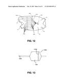 DEVICES AND METHODS FOR DENERVATION OF THE NERVES SURROUNDING THE     PULMONARY VEINS FOR TREATMENT OF ATRIAL FIBRILLATION diagram and image