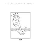 Expandable Balloon Desufflation Assembly diagram and image